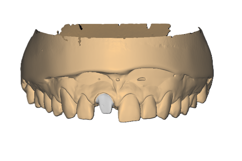 Single Crown Before